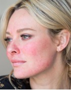 Sensitive Skin | La Jolie Beauty